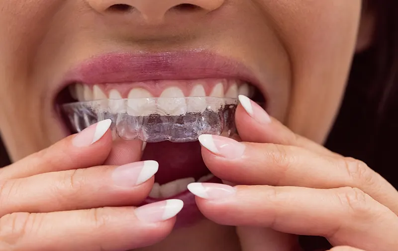 invisible-aligners-featured