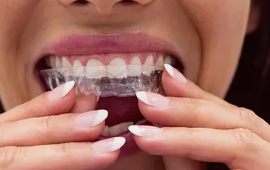 Pestana Dental & Aesthetics | Home 7 invisible aligners | Pestana Dental & Aesthetics