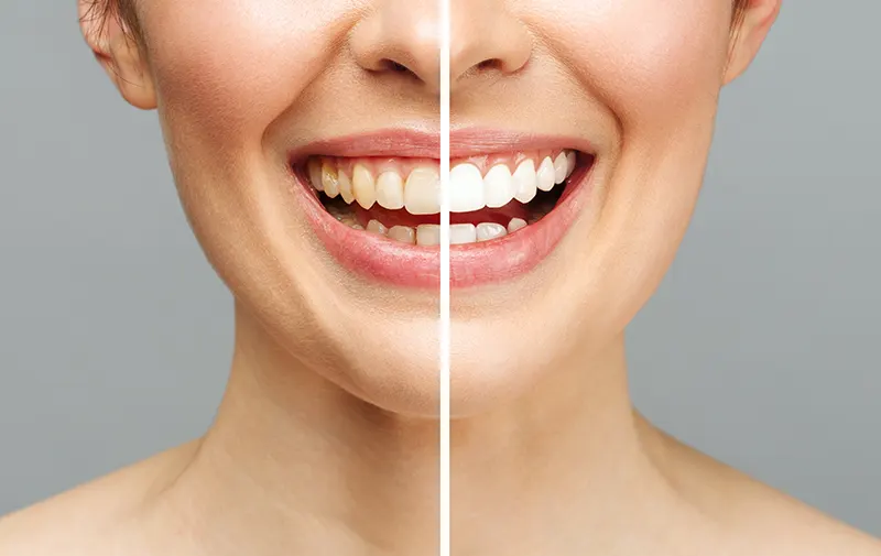 teeth-whitening-featured