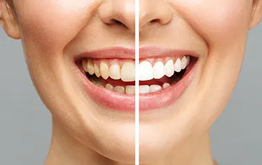 Pestana Dental & Aesthetics | Home 2 teeth whitening | Pestana Dental & Aesthetics